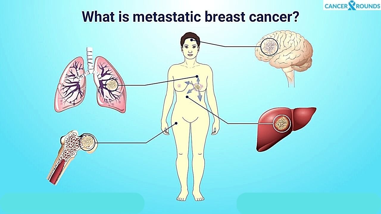 Metastasis of Breast Cancer to Other Organs