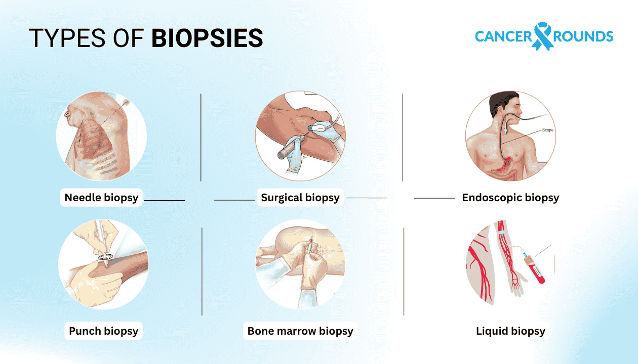 TYPES OF BIOPSIES