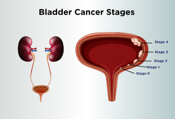 Stage 4 Bladder Cancer: Diagnosis, Treatment, and Global Survival Insights