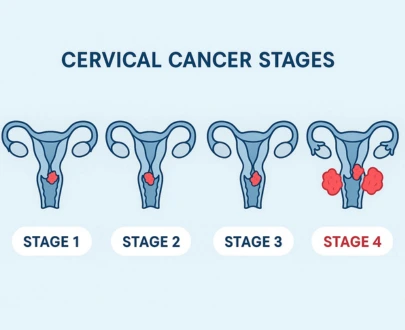 Stage 4 Cervical Cancer Treatment – A Comprehensive Global Guide