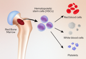 Bone Marrow Transplant for Sickle Cell Disease: A Guide to Cure and Hope